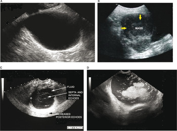 Ultrasound imaging of ovarian cancer (Chapter 22) - Ultrasonography in Gynecology Ultrasound imaging of ovarian cancer (Chapter 22) - Ultrasonography in Gynecology