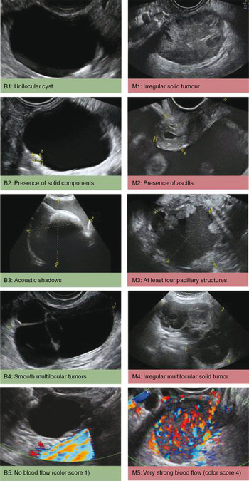 Ultrasound imaging in ovarian masses: benign or malignant? (Chapter 21) -  Ultrasonography in Gynecology