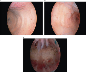 Pushing lump inferiorly produces concavity of the overlying skin (arrows)