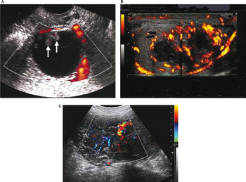 Ultrasound Imaging Of Ovarian Cancer Chapter 22 Ultrasonography In Gynecology