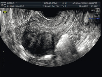 uterine fibroids images