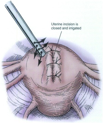 Minimally invasive surgery (Section 6) - Clinical Gynecology