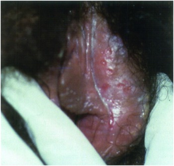 vulvar melanosis
