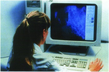 Breast cancer screening (Chapter 44) - Clinical Gynecology