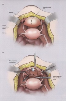 Diagnosis And Treatment Of Fistulae Chapter 32 Clinical Gynecology