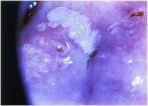 condyloma és ureaplasma