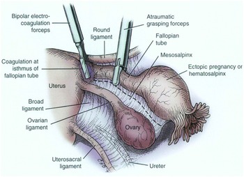 Ooforoplastia e salpingectomia laparoscópica / Oophoroplasty and  laparoscopic salpingectomy (left). 