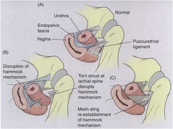 Childbirth-induced trauma to the urethral continence mechanism