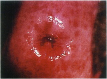 Sexually transmitted diseases Chapter 22 Clinical Gynecology