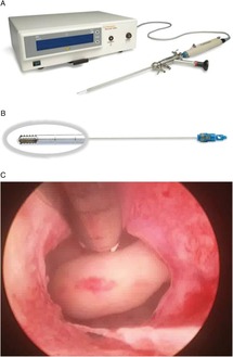 Hysteroscopic Procedures Chapter 41 Clinical Gynecology