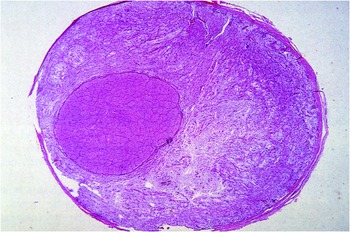 Phakomatoses (Chapter 8) - Atlas of Gross Neuropathology