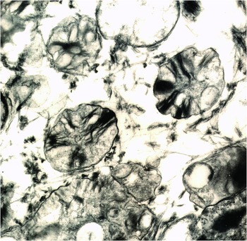 metachromatic leukodystrophy histology