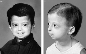 progeria mode of inheritance