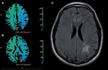 Subarachnoid Hemorrhage, Vasospasm, and Delayed Cerebral Ischemia -  Practical Neurology