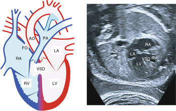 Congenital Heart Disease In The Fetus Chapter 8 Fetal Medicine
