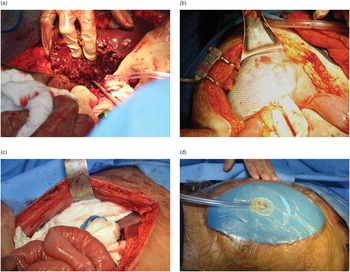 Damage control surgery (Chapter 21) - Atlas of Surgical Techniques 