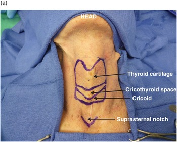 cricothyroid membrane surface anatomy