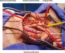 Carotid Artery And Internal Jugular Vein Injuries Chapter 8 Atlas Of Surgical Techniques In Trauma