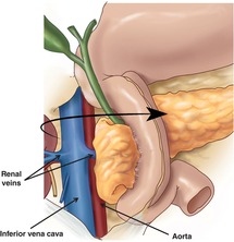 Duodenum Chapter 23 Atlas Of Surgical Techniques In Trauma