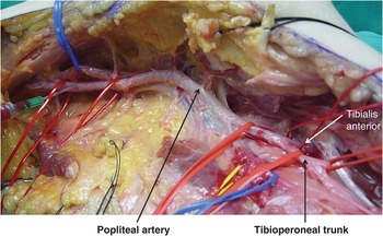 Popliteal artery (Chapter 36) - Atlas of Surgical Techniques in Trauma