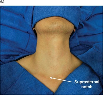 Neck (Section 4) - Atlas of Surgical Techniques in Trauma