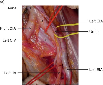 Iliac injuries (Chapter 29) - Atlas of Surgical Techniques in Trauma Iliac injuries (Chapter 29) - Atlas of Surgical Techniques in Trauma