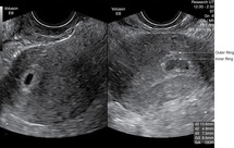 First ultrasound normal trimester Down Syndrome