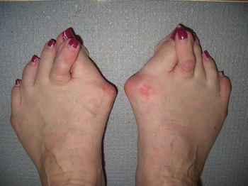 Hallux Rigidus or Arthritis of the Big Toe - Cambridge Foot and
