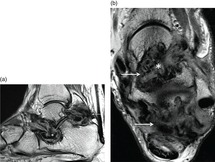 Benign Tumors Of The Foot And Ankle Chapter 17 Core Topics In Foot And Ankle Surgery