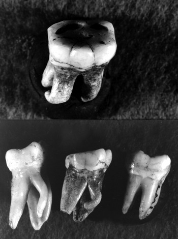 Three-Rooted Lower Molar (Chapter 40) - Human Tooth Crown and Root