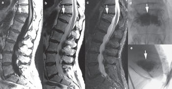Back pain (Chapter 5) - Imaging Acute Neurologic Disease