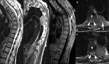 Back pain (Chapter 5) - Imaging Acute Neurologic Disease