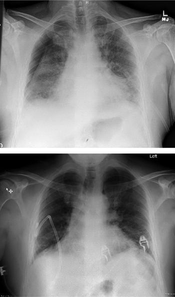 laryngeal papillomatosis pneumothorax