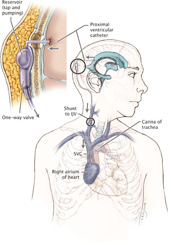 Care of the Patient Undergoing Intracranial Pressure Monitoring/ External  Ventricular Drainage or Lumbar Drainage