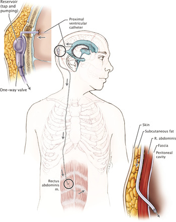 Cerebral Spinal Fluid (CSF) Shunt Systems