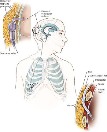 Ventriculoperitoneal (VP) Shunt - Together by St. Jude™