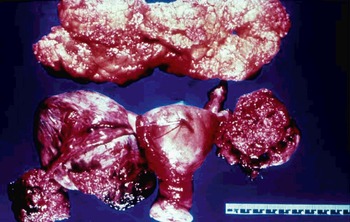 Lower gastrointestinal bleeding as a presentation of miliary tuberculosis |  Gastroenterología y Hepatología