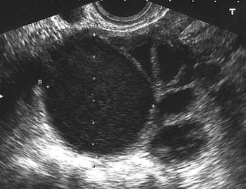 Endometriosis Of The Ovary Chapter 12 Altchek S Diagnosis And Management Of Ovarian Disorders