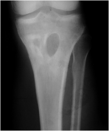 Infections of bones and joints Chapter 8 Pathology of Bone and