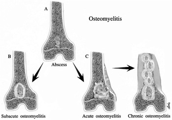 Infections of bones and joints Chapter 8 Pathology of Bone and