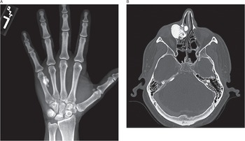 Primary bone tumors (Chapter 12) - Pathology of Bone and Joint