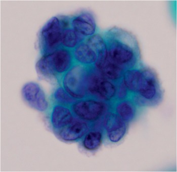 Basal Cells In Pap Smear
