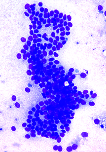 Cytopathology Of The Breast Chapter 11 Differential Diagnosis In Cytopathology