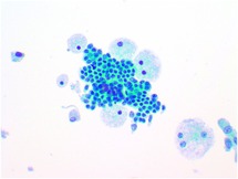 Cytopathology Of The Breast Chapter 11 Differential Diagnosis In Cytopathology