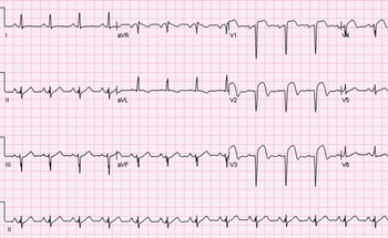 anterior myocardial infarction ecg