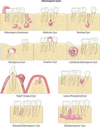 nasolacrimal cyst oral