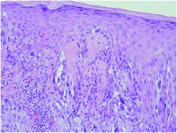 melanotic macule histology Mucocutaneous Pigmented Lesions, Nevi and Melanoma (Chapter 4)