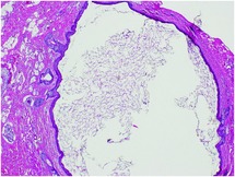 sinus cysts and polyps