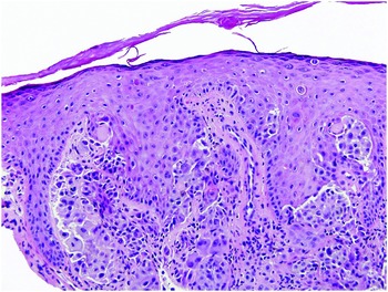 Mucocutaneous Pigmented Lesions, Nevi and Melanoma (Chapter 4)