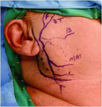 Transaxillary robotic-assisted thyroid surgery: technique and results of a  preliminary experience on the Da Vinci Xi platform | BMC Surgery | Full Text